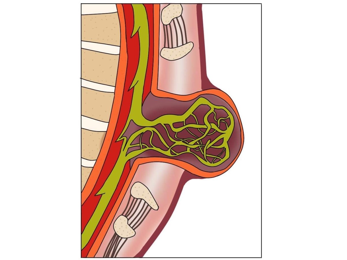 Mielomeningocele, uma espinha bífida aberta com deslocação da medula espinal e dos nervos espinais.
